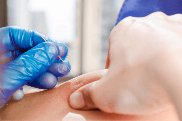 Dry Needling